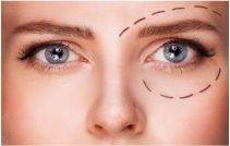 Blue eyed woman with markings below eye before plastic surgery